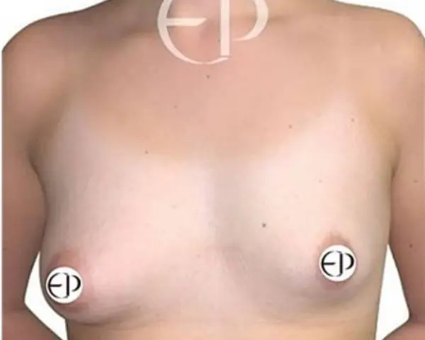 type-2-tubular-breasts