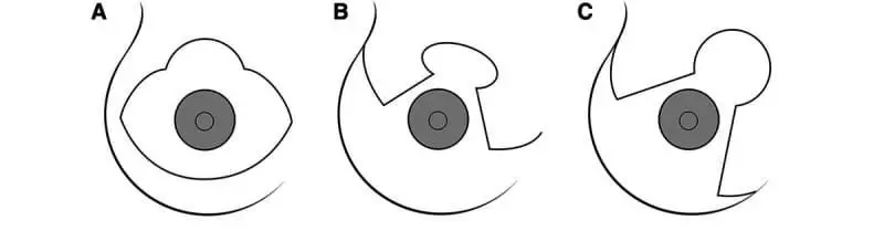 Anchor scar breast lift, Nipple scar location