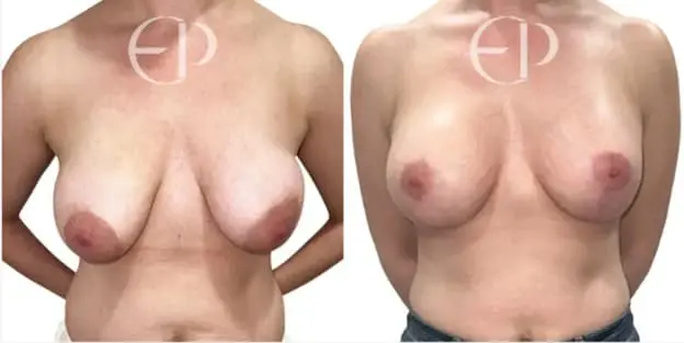 breast uplift