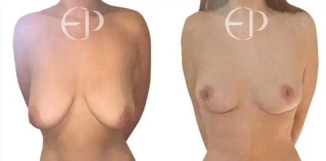 Before and after picture of breast uplift surgery