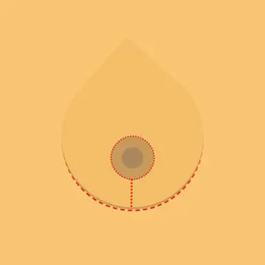 breast lift scar diagram