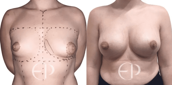 Asymmetric breast development.