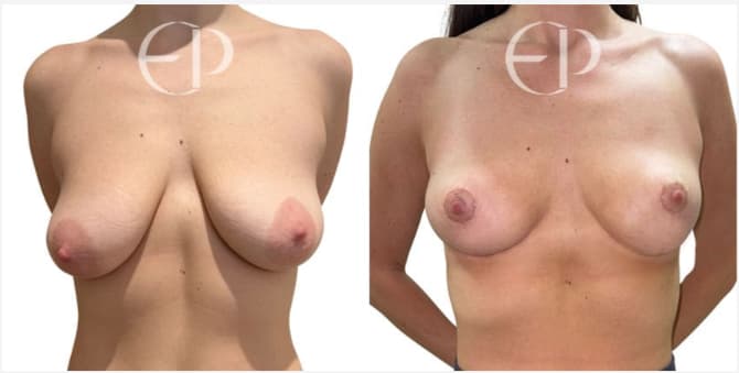 Before and after breast lift image