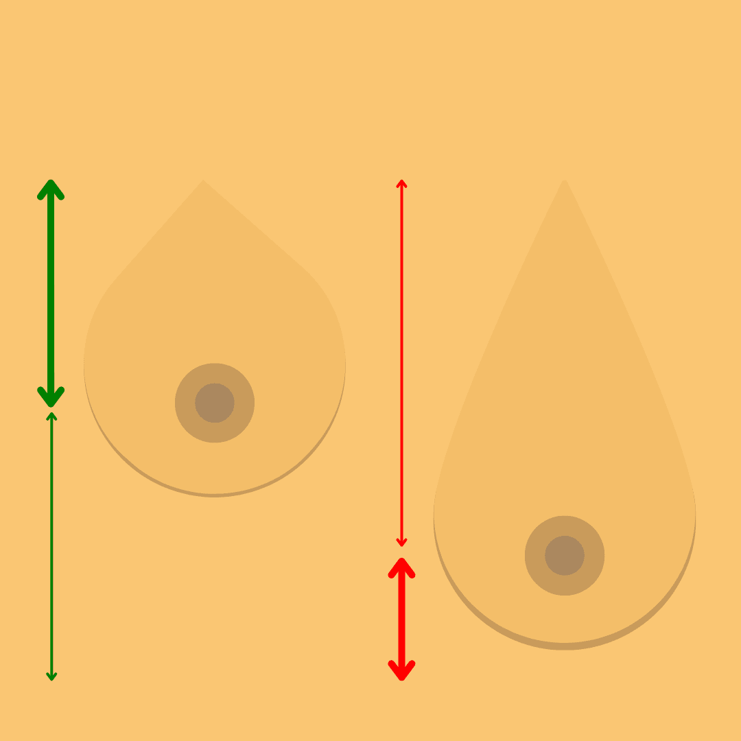 breast lift diagram 