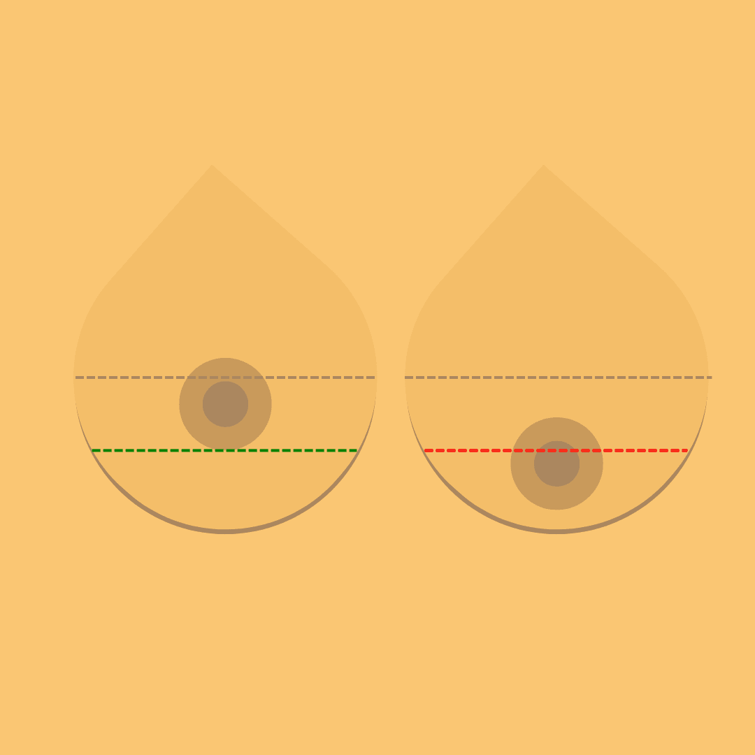 breast lift diagram 